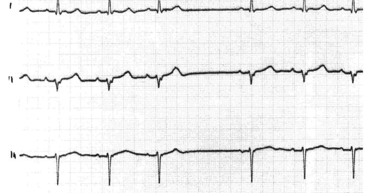 Interpret The ECG Finding