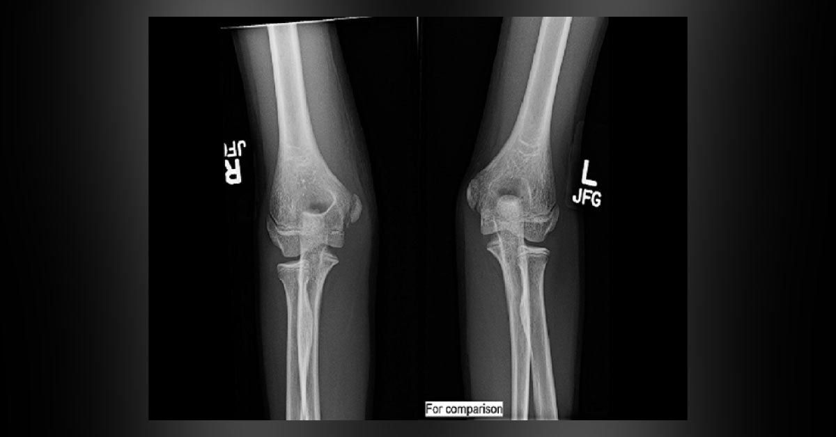 How Will You Manage This Kind Of Fracture?
