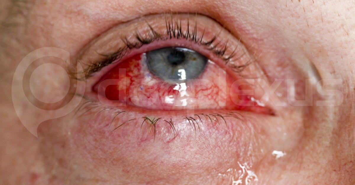 Importance Of Red Eye In Ophthalmology