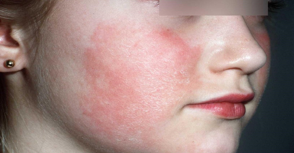 Spot This Dermatological Condition