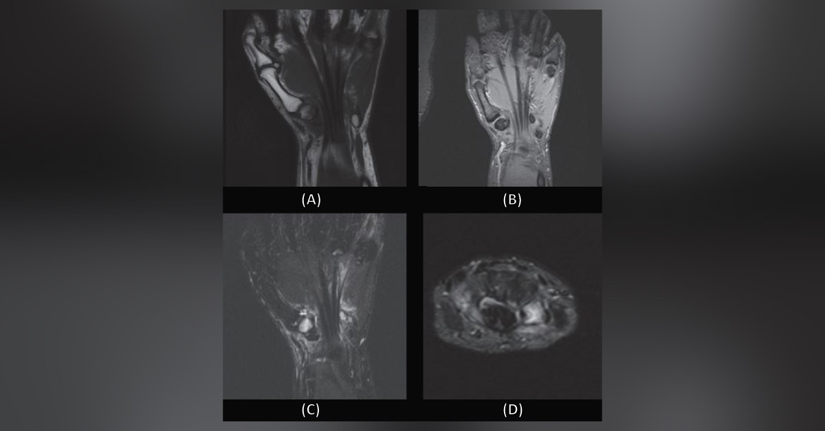Mild Pain at The Base Of The Thumb