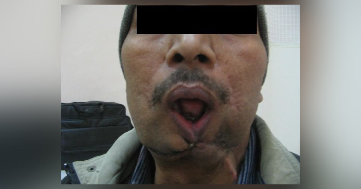 Microvascular Lower Jaw Reconstruction Surgery After Multiple Failed Attempts - A Difficult Case