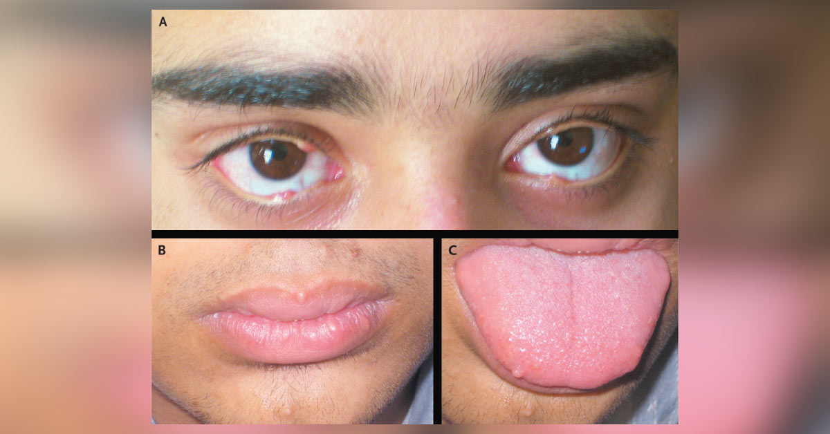 Papules On The Eyelids, Lips, and Tongue In A Teenager Boy