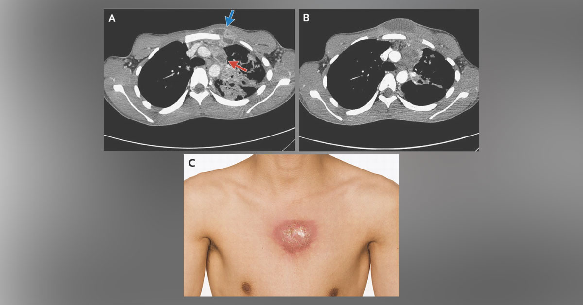 Suggest Management For This Subcutaneous Abscess