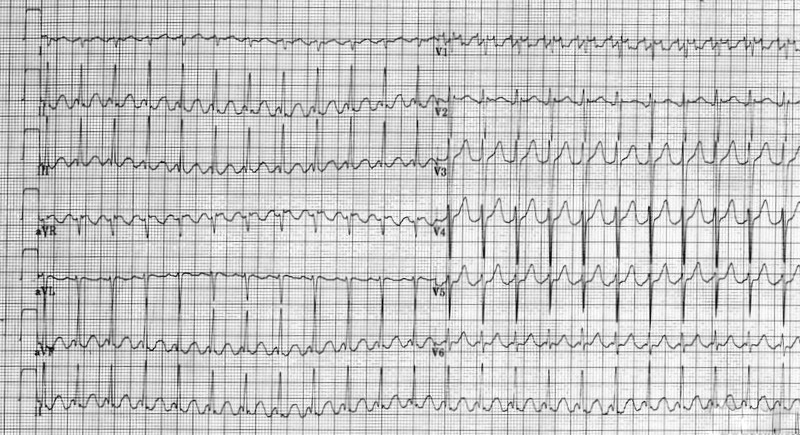 Interpret This ECG