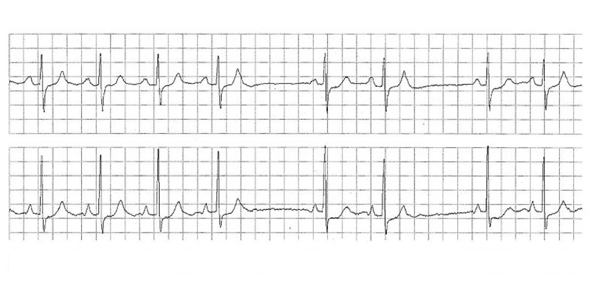 Is This A Sinoatrial Block