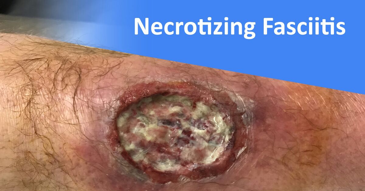 Antibiotic Protocol For Necrotizing Fasciitis
