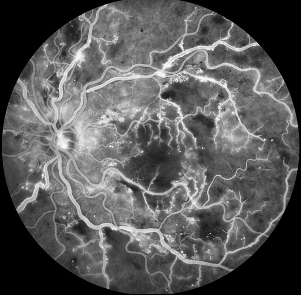 Advantages Of Fundus Fluorescence Angiography