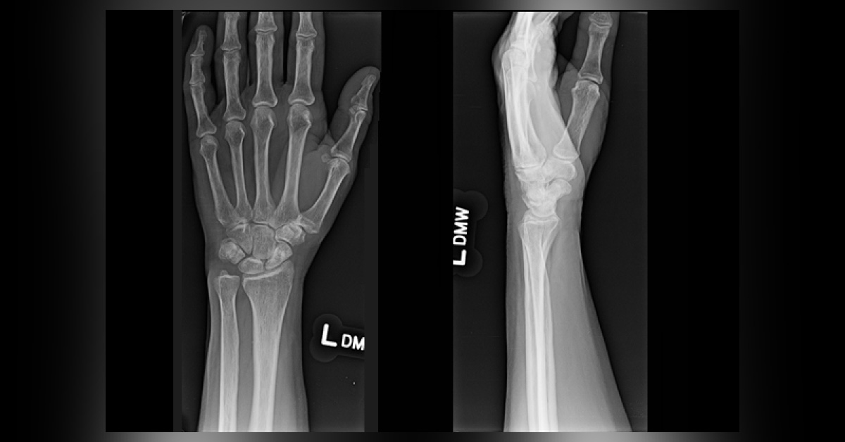 Recommend The Best Treatment For This Fracture