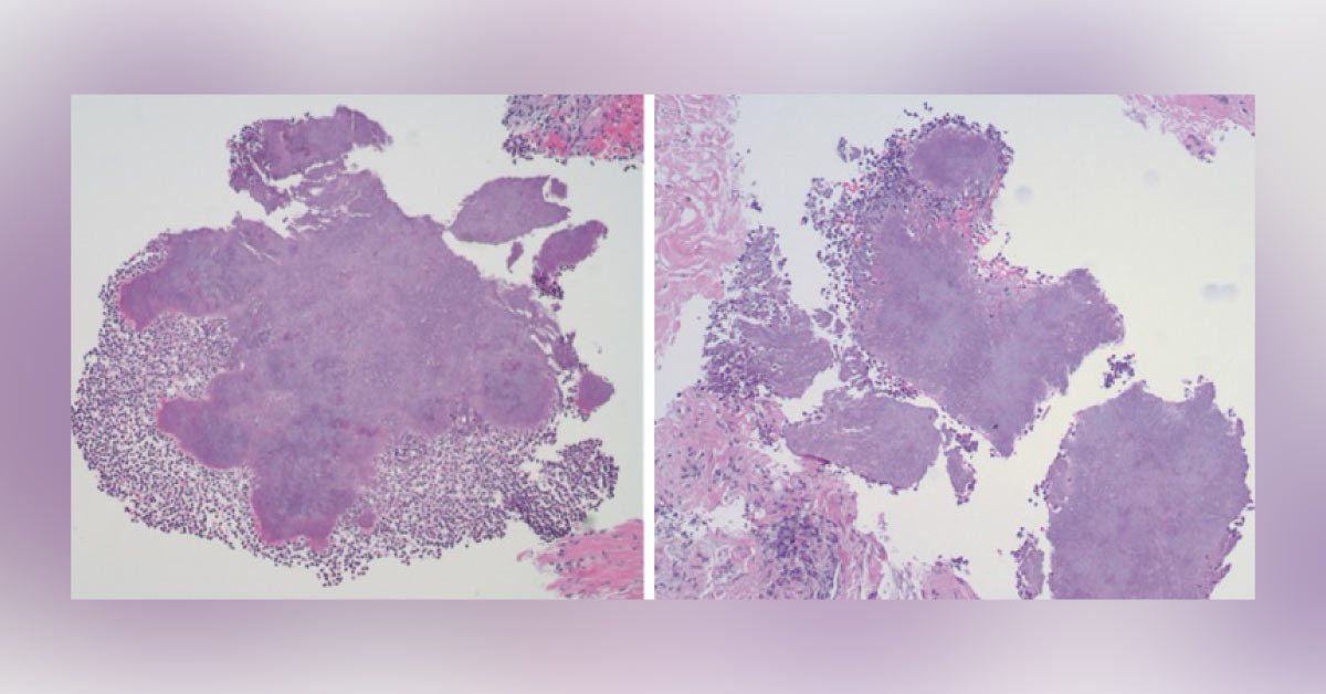 Slow Growing Neck Mass, What Does The Biopsy Reveal?