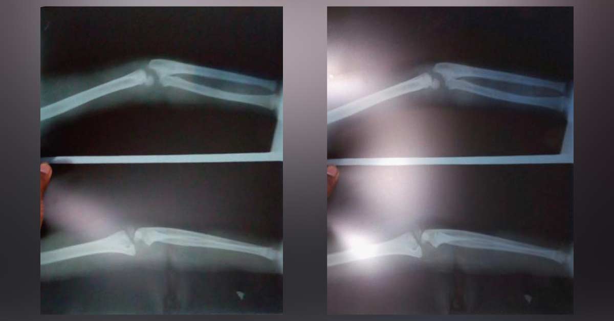 Fracture Lateral Malleolus