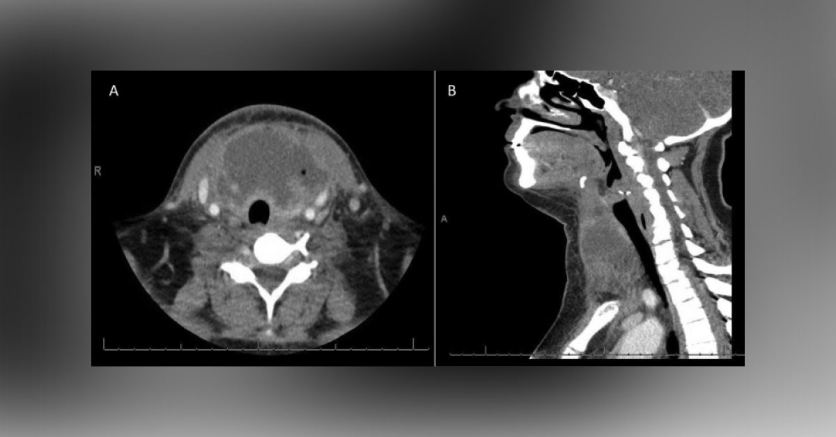 Red, Swollen Anterior Neck