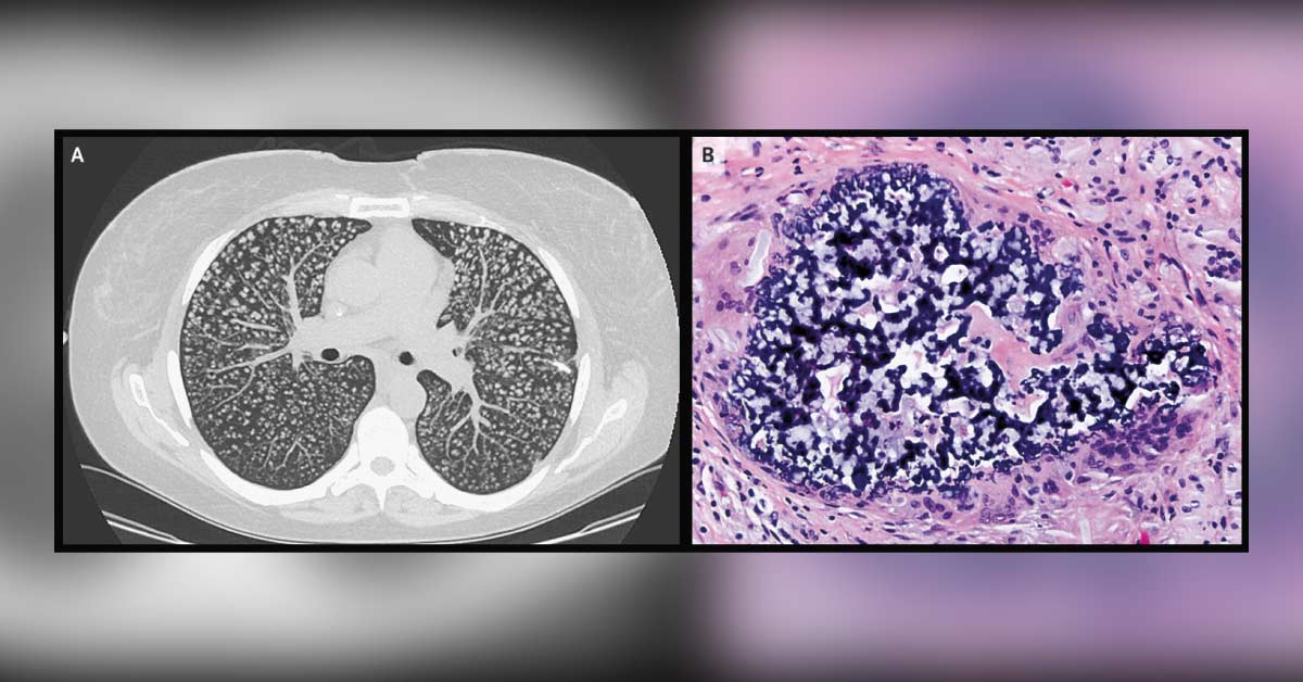 Is This A Case Of Pulmonary Foreign Body Granulomatosis