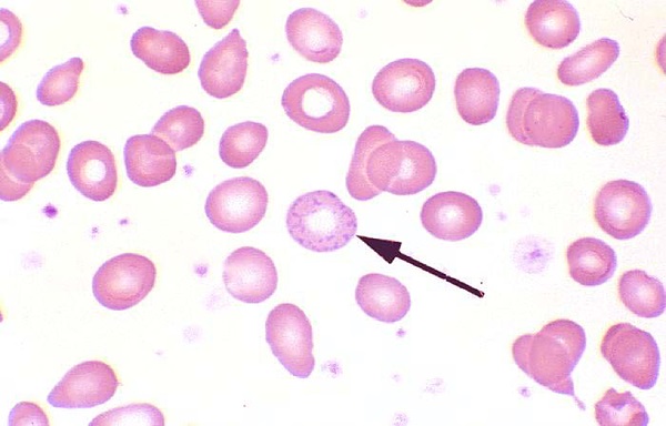 Interpret This Blood Smear
