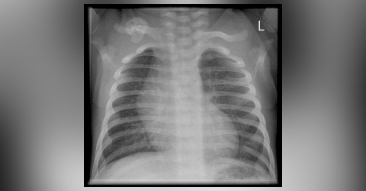 Unexpected Radiography Finding, Can You Identify?