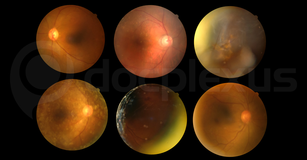 Common Eye Disorders Seen In Rheumatoid Arthritis Patients