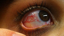 A Brief Scenario Of Phakomatosis
