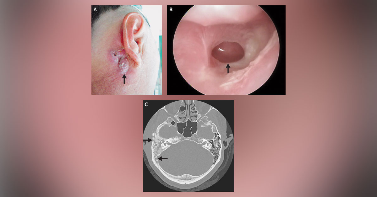 Is This Otitis