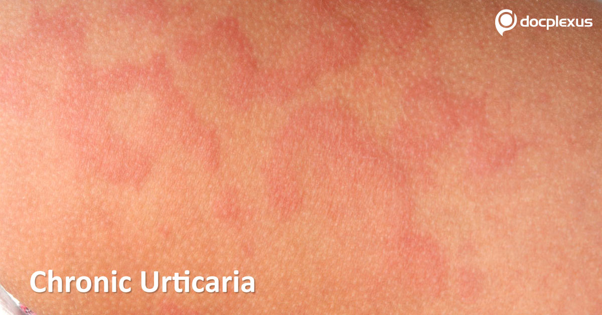 Chronic Urticaria And Angioedema, Management Guide
