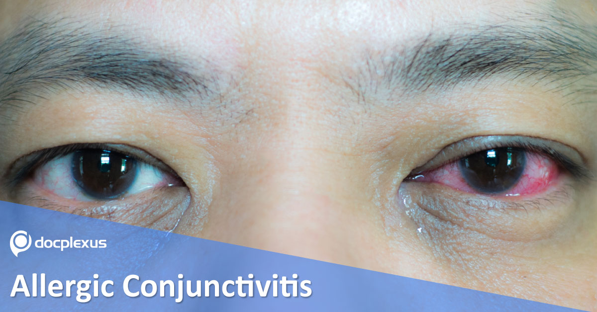 Topical Cetirizine For Treating Allergic Conjunctivitis
