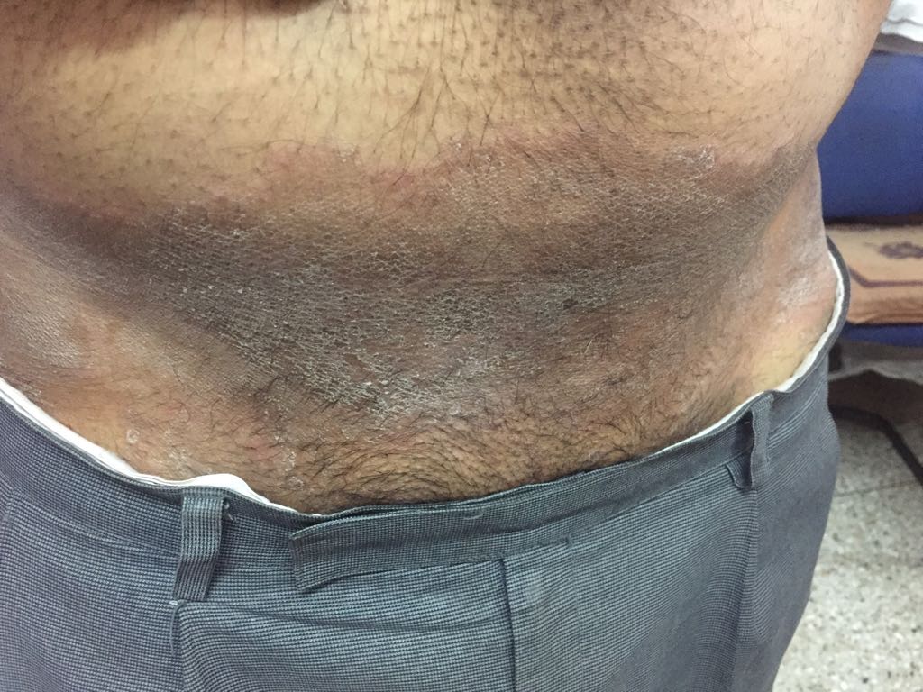 What Are These Skin Lesions? 