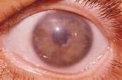 Very Brief Review Of Congenital Associations With Congenital Corneal Dystrophy
