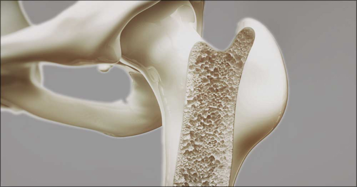 When Should A Patient Be Tested For Osteoporosis?