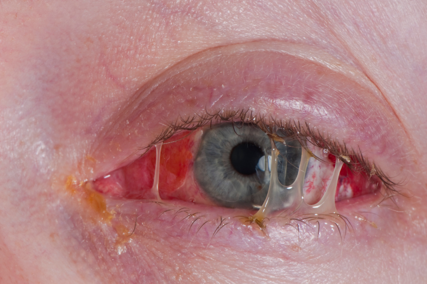 Ocular Manifestations Of Psoriasis