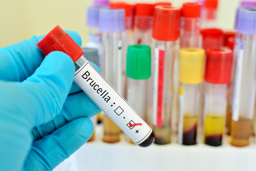 Ocular Manifestations Of Brucellosis