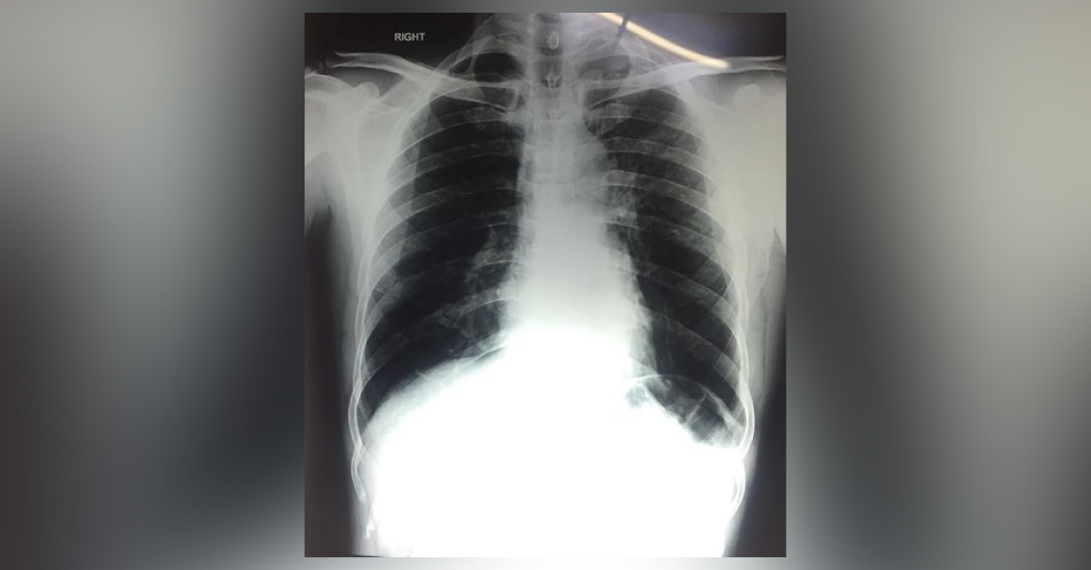 What Is The Cause Of Hemoptysis In This Patient? 