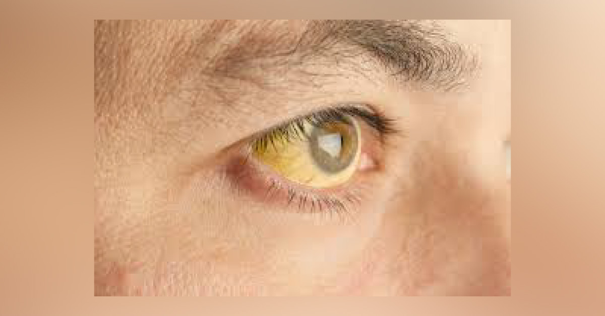 Ocular Complications Of Scarlet Fever