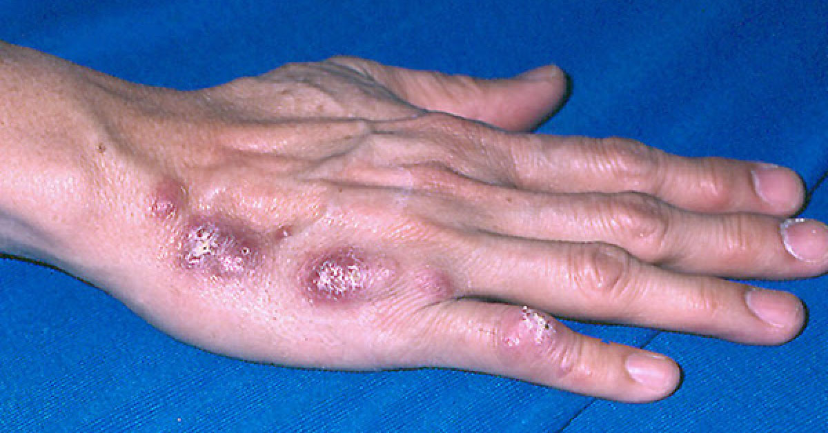 What Is The Best Treatment?