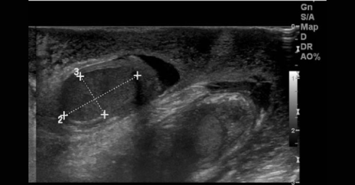 A Case Of Bilateral Scrotal Pain