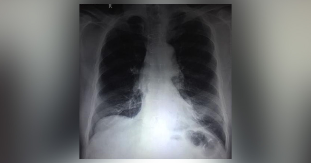 What Is There In This X Ray Of 80 Years Old Man?