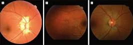Brief Review On Toxic Amblyopia