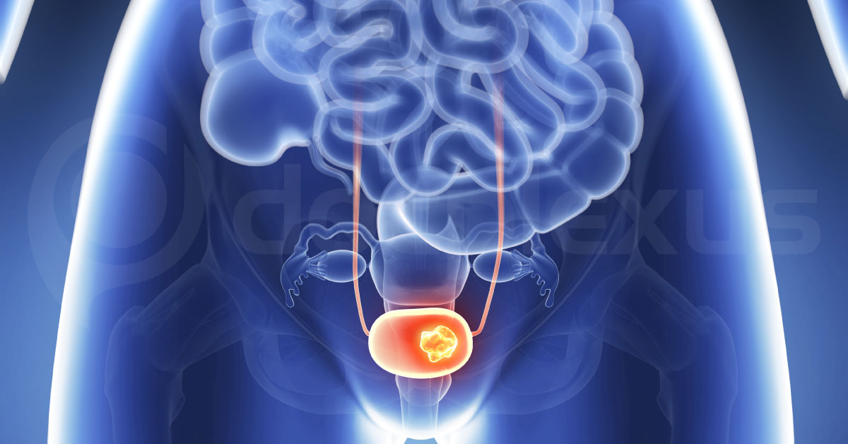 Bladder Cancer And Nano-Chemo Particles
