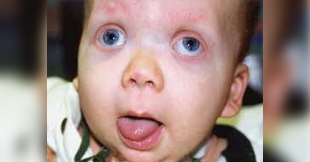 Occular Manifestatios Of Downs Syndrome A Brief Rview
