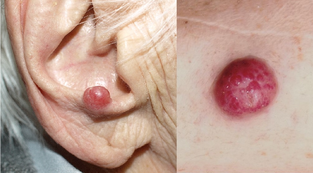 Merkel Cell Carcinoma: A Brief Overview
