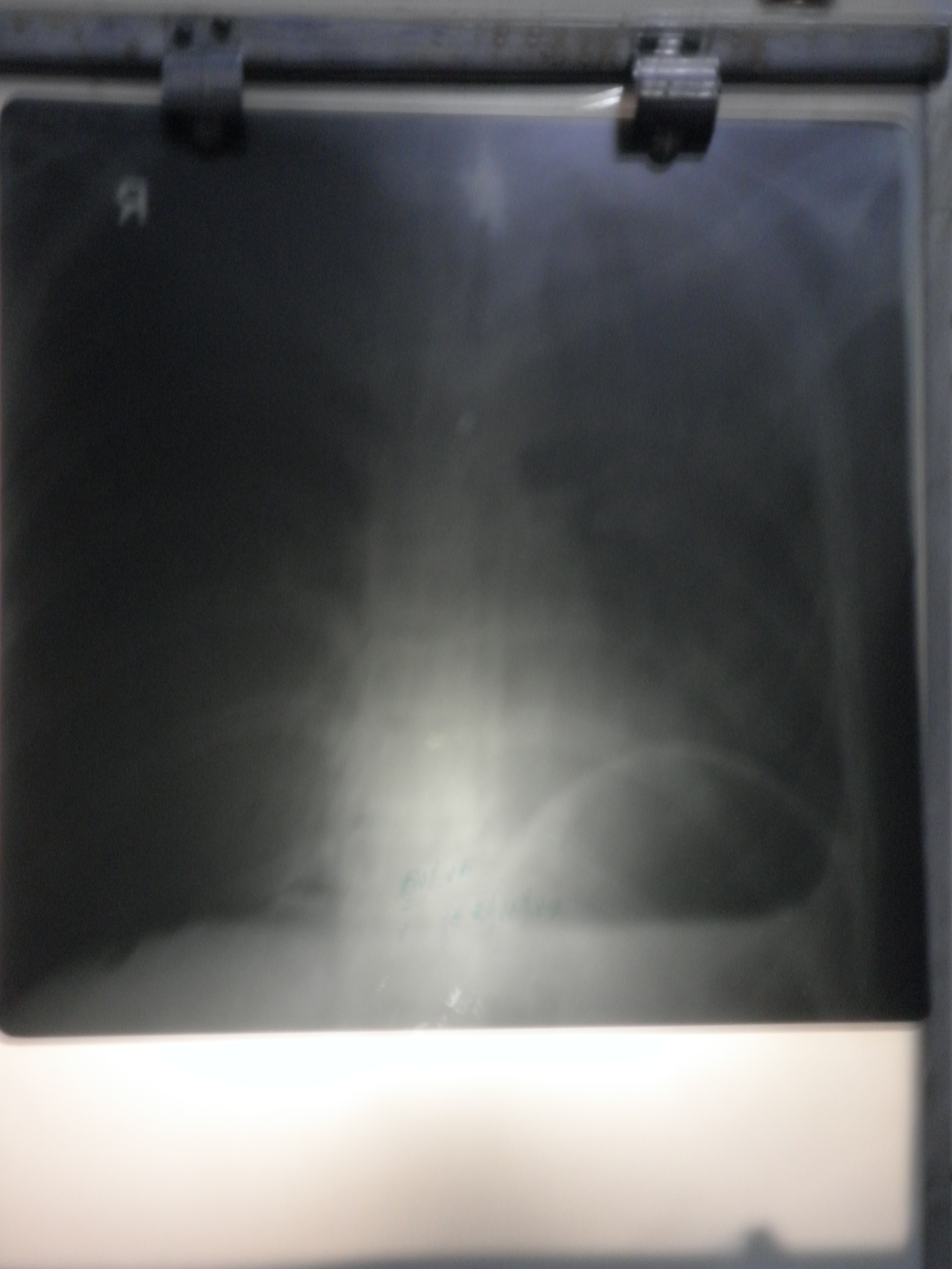 Identify The Findings Of X-Ray Chest PA View
