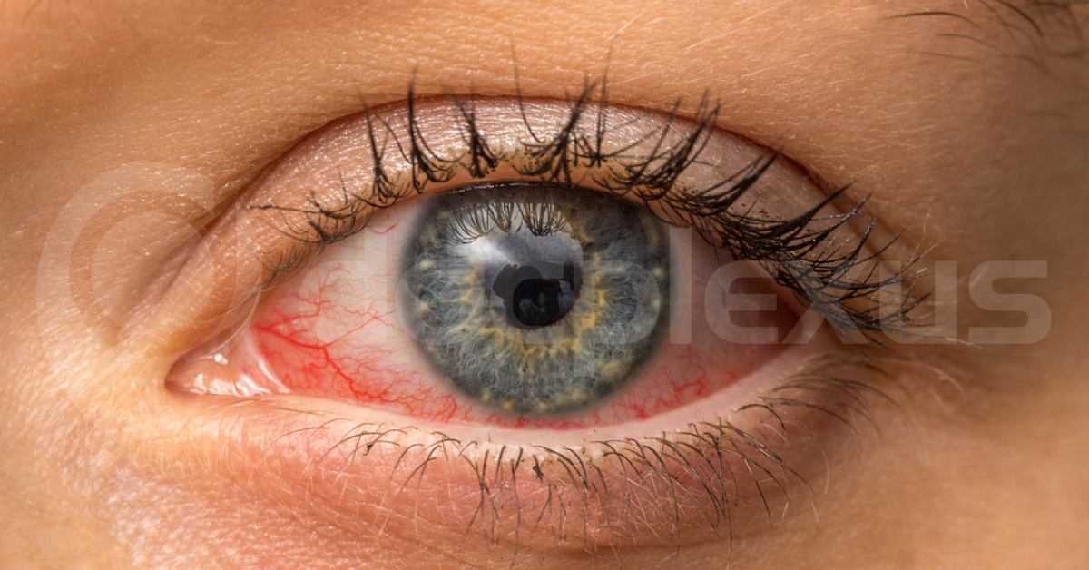 Ocular Manifestations Of Lyme Disease