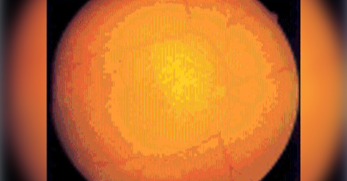 Ophthalmic Complications After Spinal Surgery