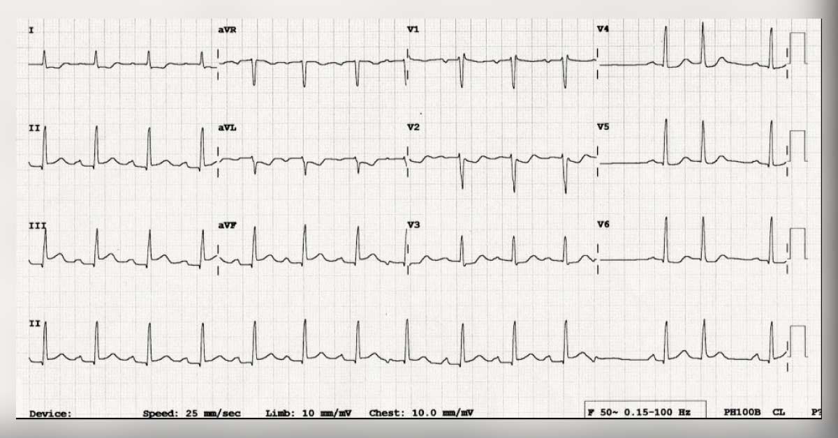 Interpret This ECG