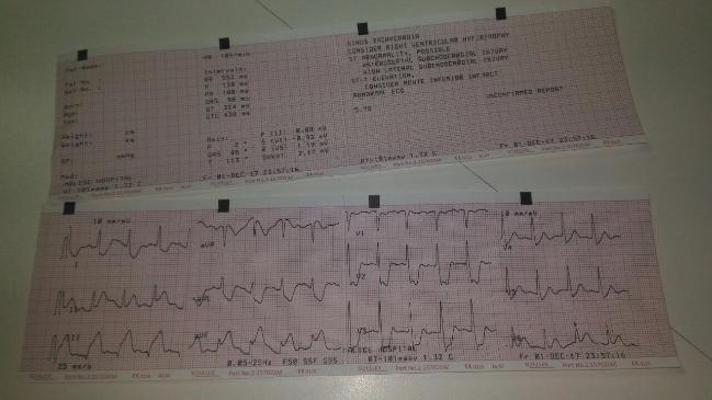 How To Manage Case IHD ACS In Tertiary Care Set Up