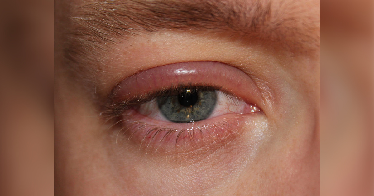 Ocular Manifestations Of Oral Contraceptives