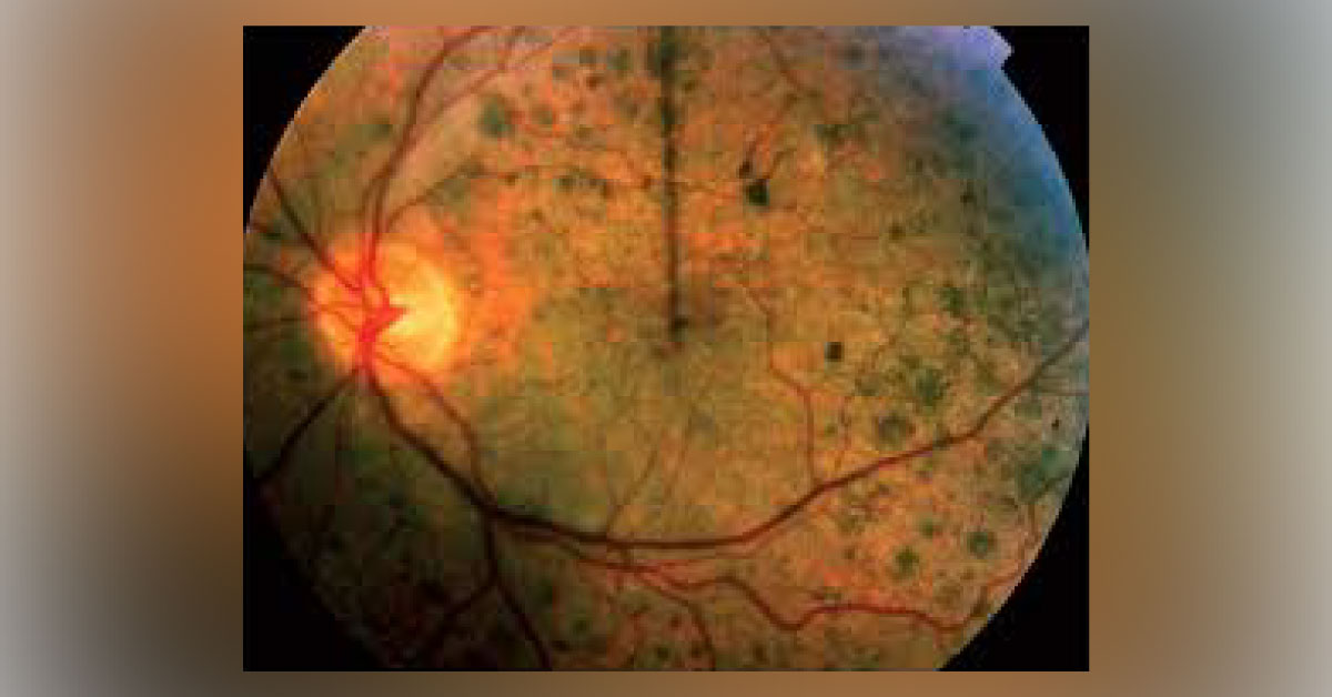 Ocular Manifestations Of Rubella A Brief Review