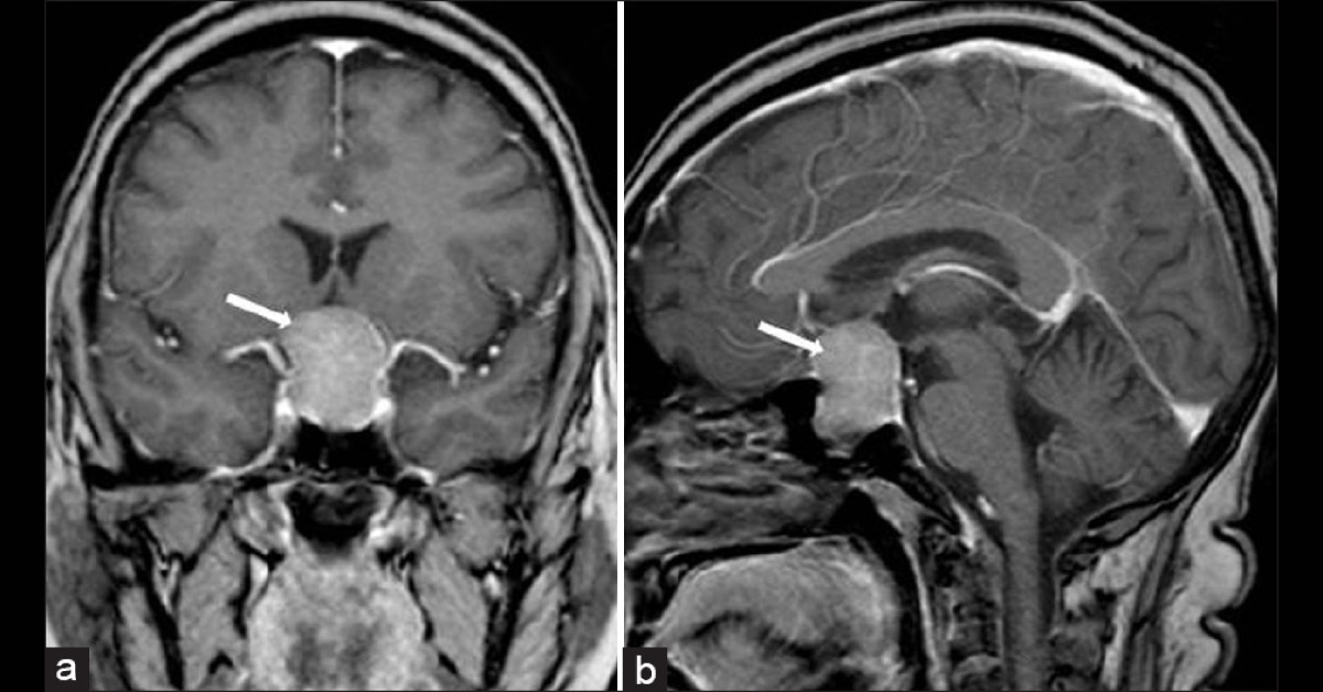 Ocular Manifestations Of Pituitary Tumors A Brief Review
