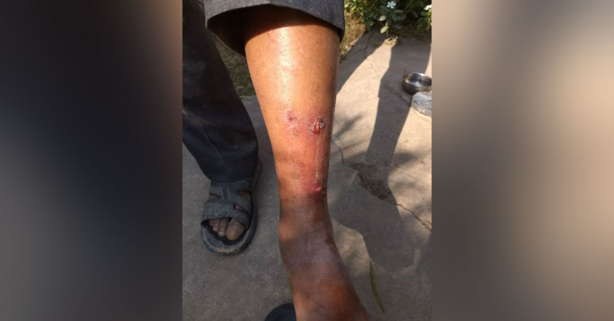 Diabetic Leg Wound
