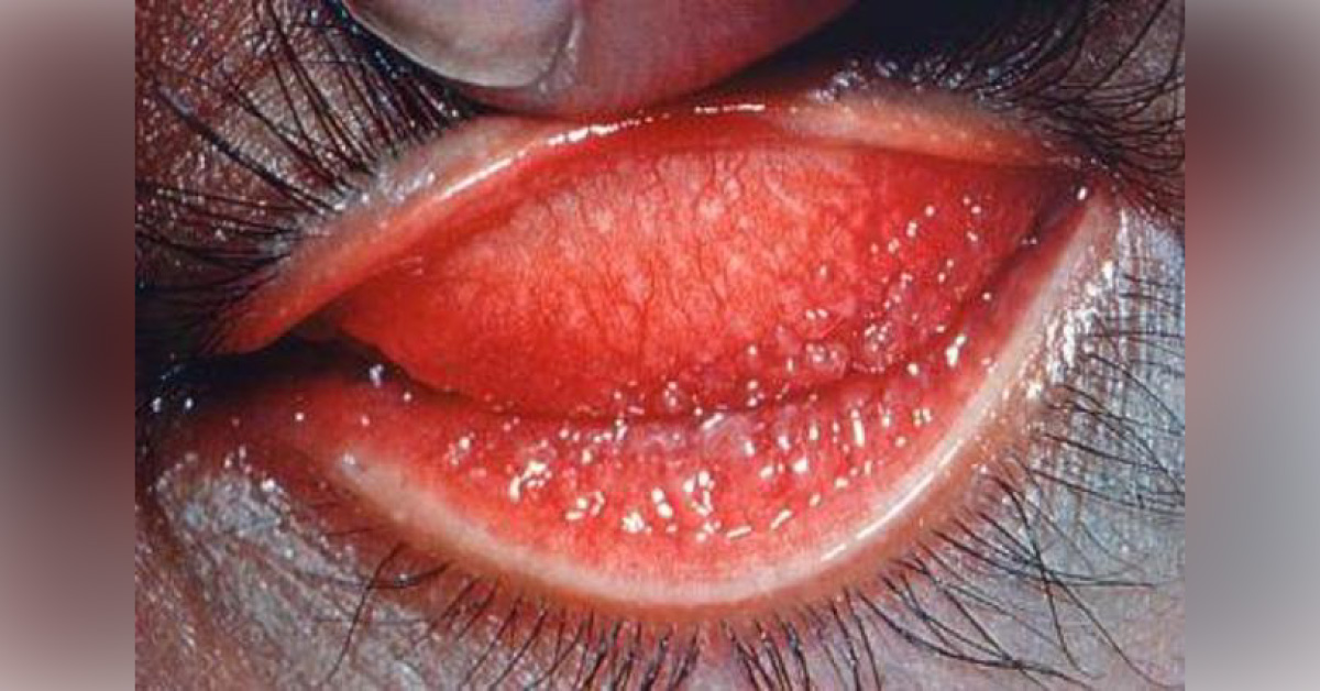 Ocular Manifestations Of Lymphogranuloma Venereum