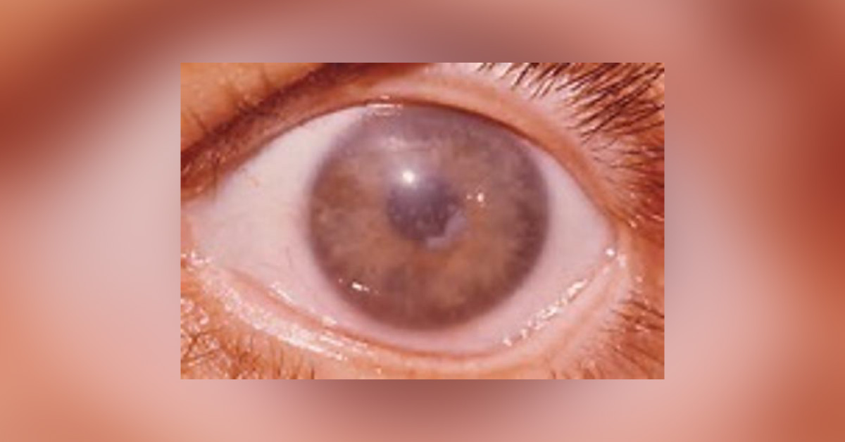 Ocular Complications Of Crohn's Disease