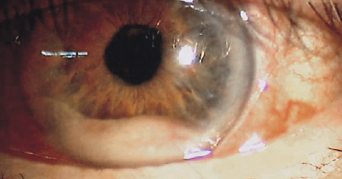 Ocular Manifestations Of Multiple Myeloma A Brief Review
